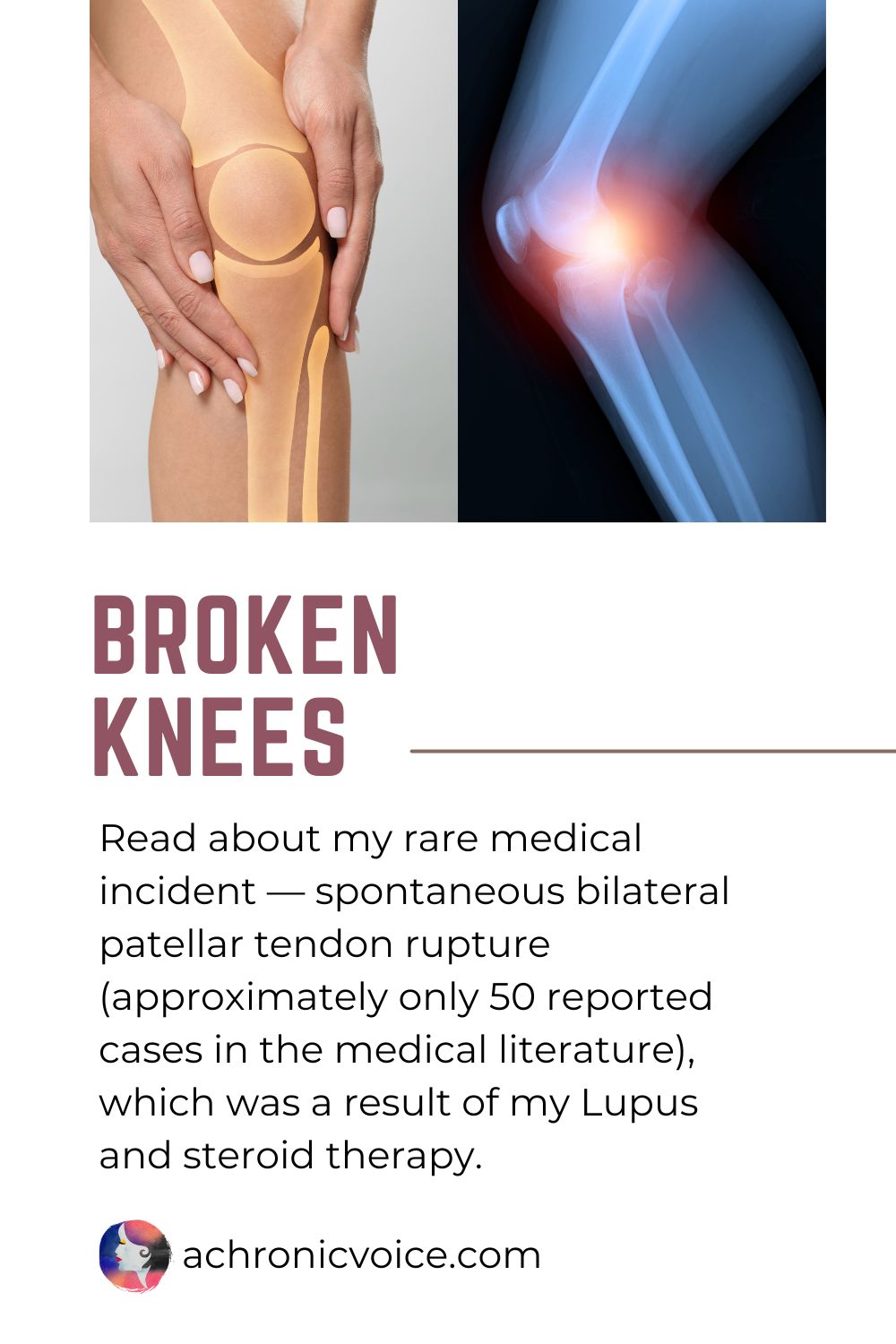 Broken Knees — Read about my rare medical incident — spontaneous bilateral patellar tendon rupture (approximately only 50 reported cases in the medical literature), which was a result of my Lupus and steroid therapy. (A Chronic Voice .com)