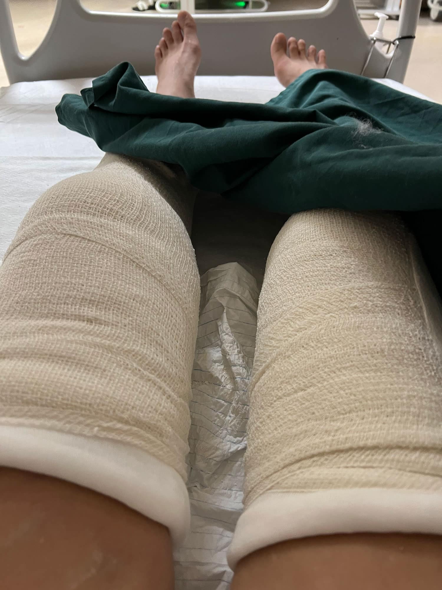 Backslab for Spontaneous Bilateral Patellar Tendon Rupture