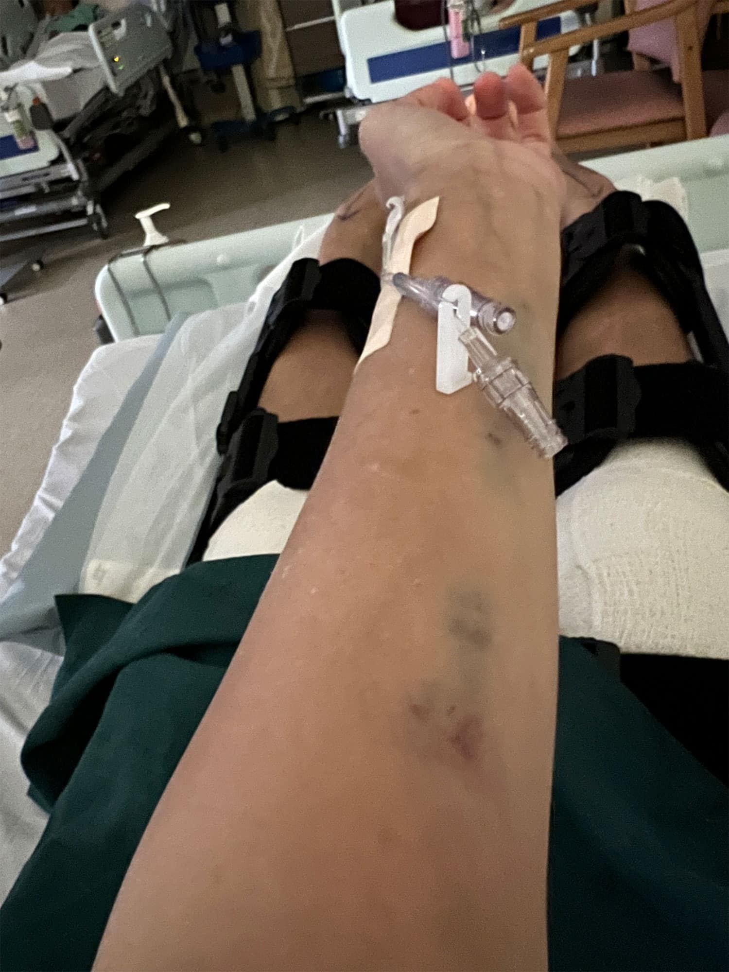 Bruises from blood tests and setting a plug in the hospital