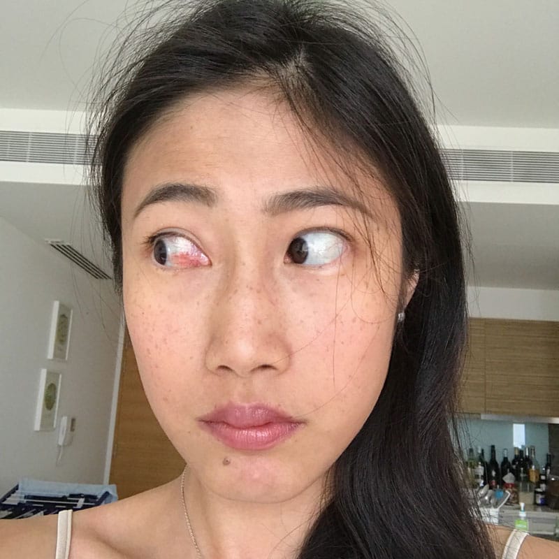 Inflammation from sjogren dry eyes - find out more at www.achronicvoice.com