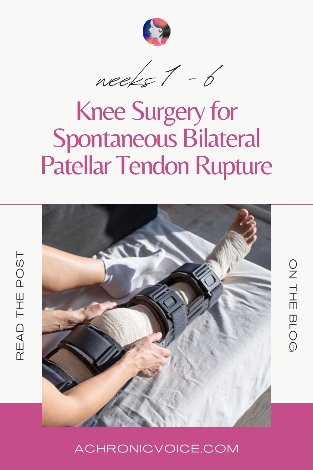 Weeks 1 to 6: Knee Surgery for Spontaneous Bilateral Patellar Tendon Rupture. Read the post on the blog, A Chronic Voice .com.